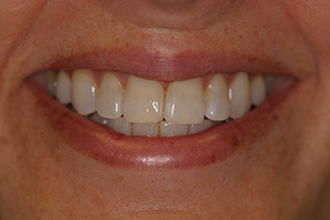 composite after, restorative dentistry Evanston IL, Morton Grove IL, Niles IL