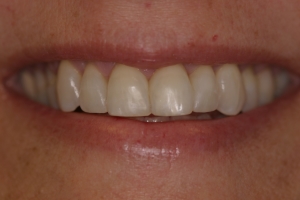 After Bonding, cosmetic dentistry Morton Grove, IL