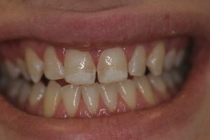 Before teeth whitening, cosmetic dentistry Niles, IL