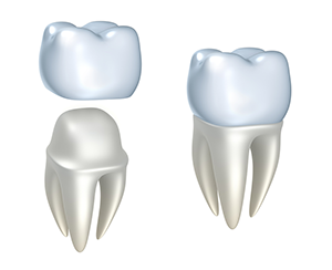 illustration of dental crown assembly, restorative dentistry Skokie, IL