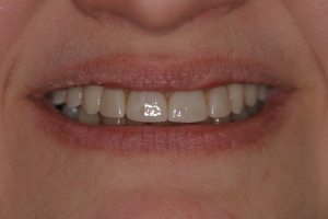 teeth after dental implants Skokie, IL, Evanston, Morton Grove, Niles, Wilmette, Glenview, Northbrook, Winnetka, & Northfield, IL.
