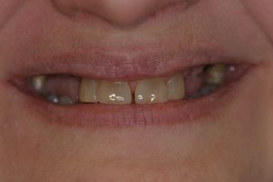 mouth and teeth before dental implants Skokie, IL