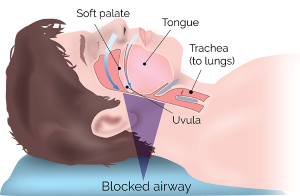 illustration of blocked airway, Skokie, IL sleep apnea Evanston, Morton Grove, Niles, Wilmette, Glenview, Northbrook, Winnetka, & Northfield, IL. 