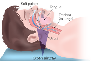 illustration of open airway, sleep apnea Skokie, IL, Evanston, Morton Grove, Niles, Wilmette, Glenview, Northbrook, Winnetka, & Northfield, IL.